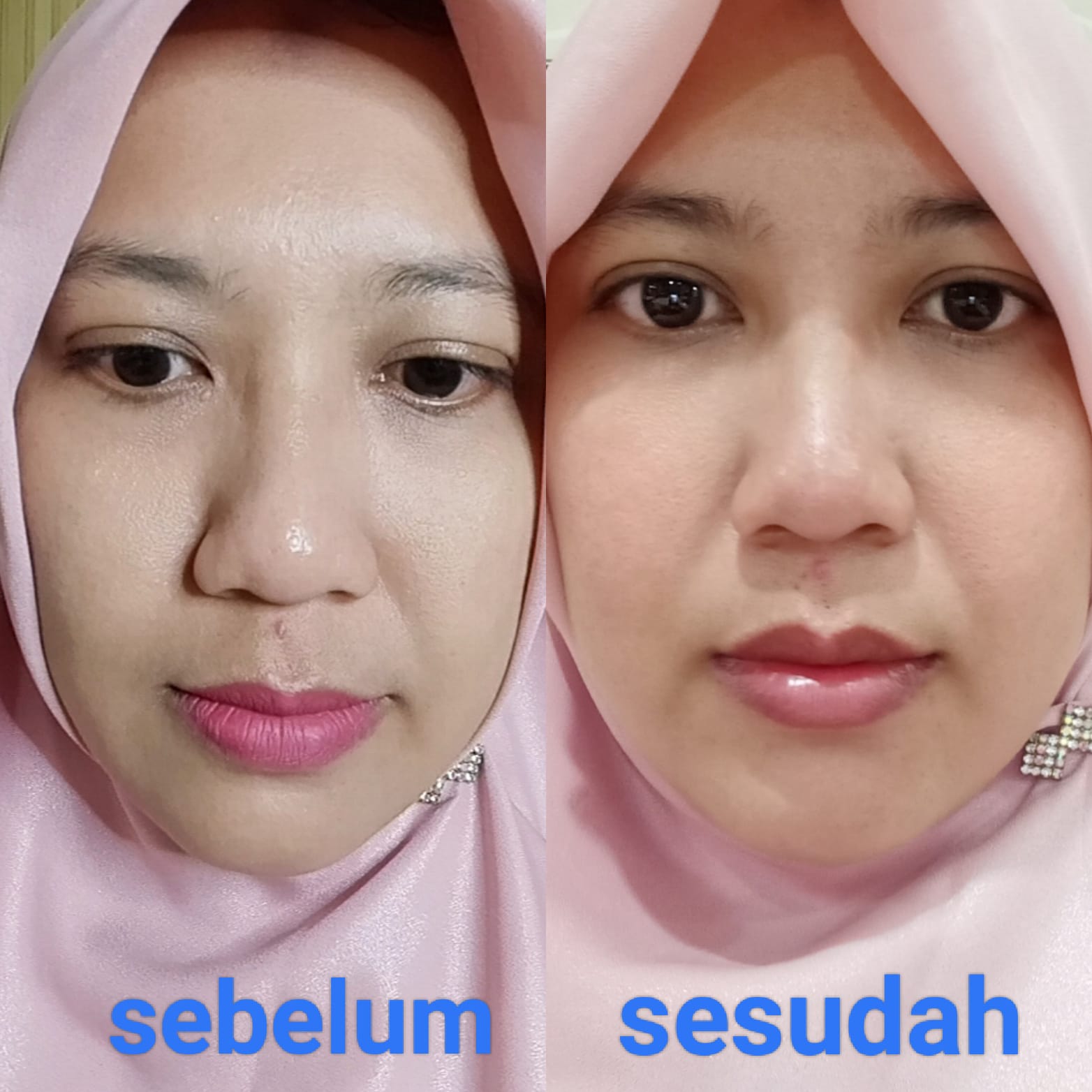 Mencari Glowing Skin? ZAP Clinic Setia Budi Semarang Punya Solusinya! 13 Mencari Glowing Skin? ZAP Clinic Setia Budi Semarang Punya Solusinya!